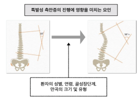 청소년 특발성 측만증은 진행하는가?